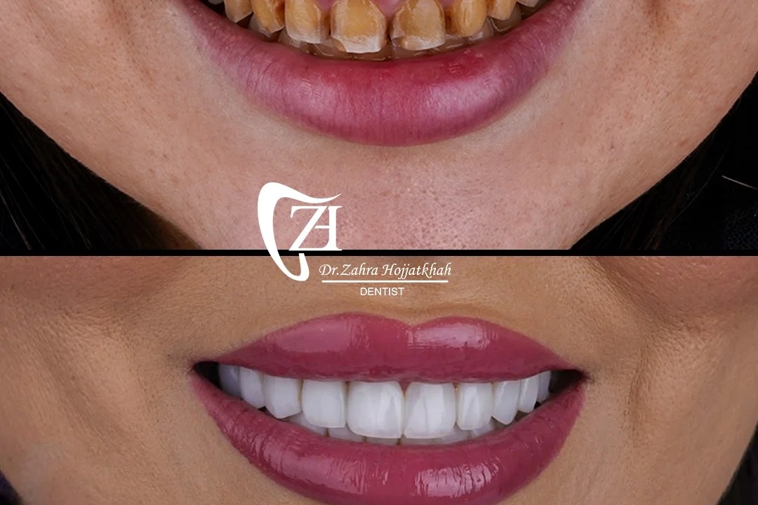 اصلاح طرح لبخند کلینیک دندانپزشکی دکتر حجت خواه