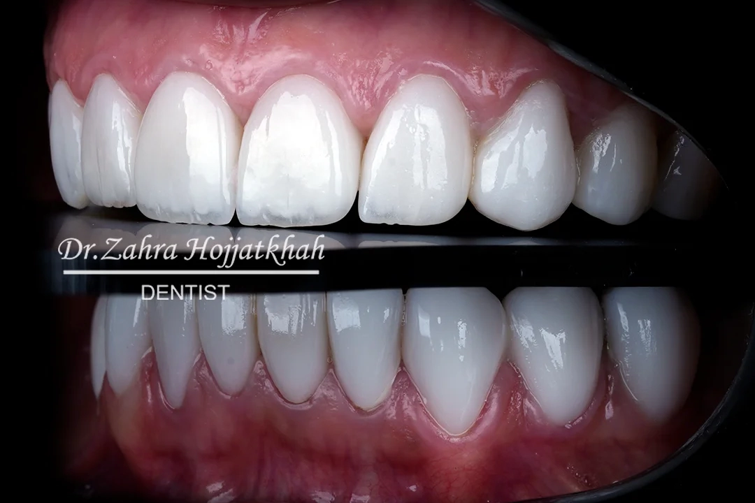 لمینت سرامیکی در کلینیک دندانپزشکی دکتر حجت‌خواه
