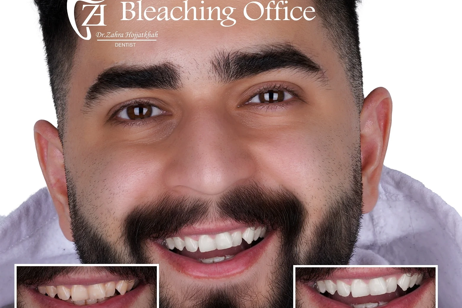 بلیچینگ سفیدکردن دندان در کلینیک دندانپزشکی دکتر حجت‌خواه